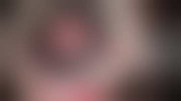 Trauma induced dislocation of IOL & capsular bag