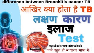 TB( Tuberculosis) के लक्षण , कारण ,इलाज ,टेस्ट |by DOCTOR Lab