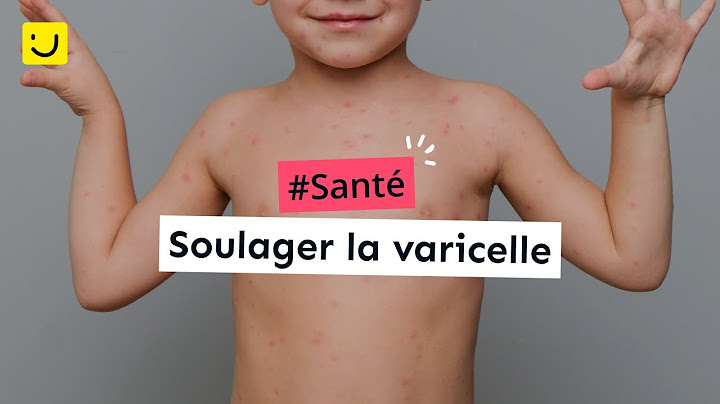 Soulager la varicelle