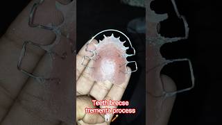 teeth brecse trementa process 🦷 दांतों ब्रेक्स कैसे लगाया जाता है 🦷#dentist #video #viral #shorts🦷📈