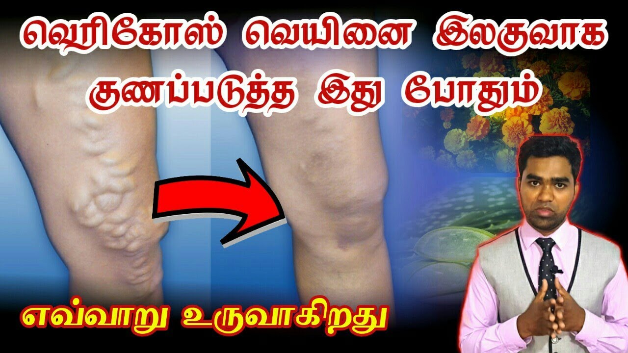 varicose veins ayurvedic treatment in tamil வெரிகோஸ் வெயின் நோயை இலகுவாக எவ்வாறு குணப்படுத்துவது | Varicose vein herbal treatment in tamil