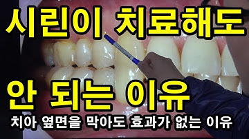 시린이 치료해도 안 되는 이유 덴티튜브 008화