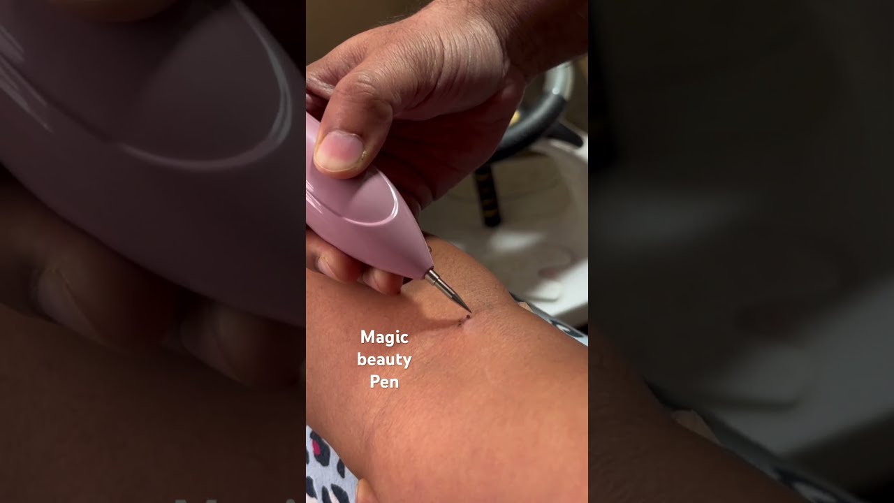 Watch Skin Tags Vanish Painlessly With The Veentus Wart Remover Pen Say Goodbye To Pesky Moles 