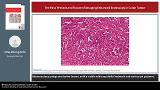 The Past, Present and Future of Imaging Enhanced Endoscopy in Colon Tumor