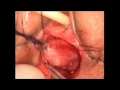 Rectovestibular fistula,(Vestibular Anus ) & Trans-Fistula  Ano-Recto-Plasty