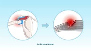Rotator Cuff Impingement Causes Organelle Damage and Tenocyte Apoptosis