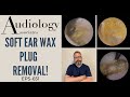 SOFT EAR WAX PLUG REMOVAL - EP651