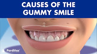 Causes of GUMMY SMILE - Do you show a lot of GUM when you SMILE? ยฉ