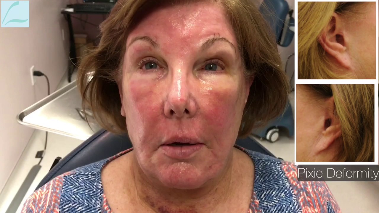 Pixie Ear Correction with Facelift Recovery Journey - YouTube