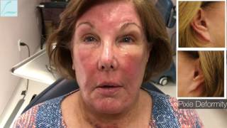 Pixie Ear Correction With Facelift Recovery Journey