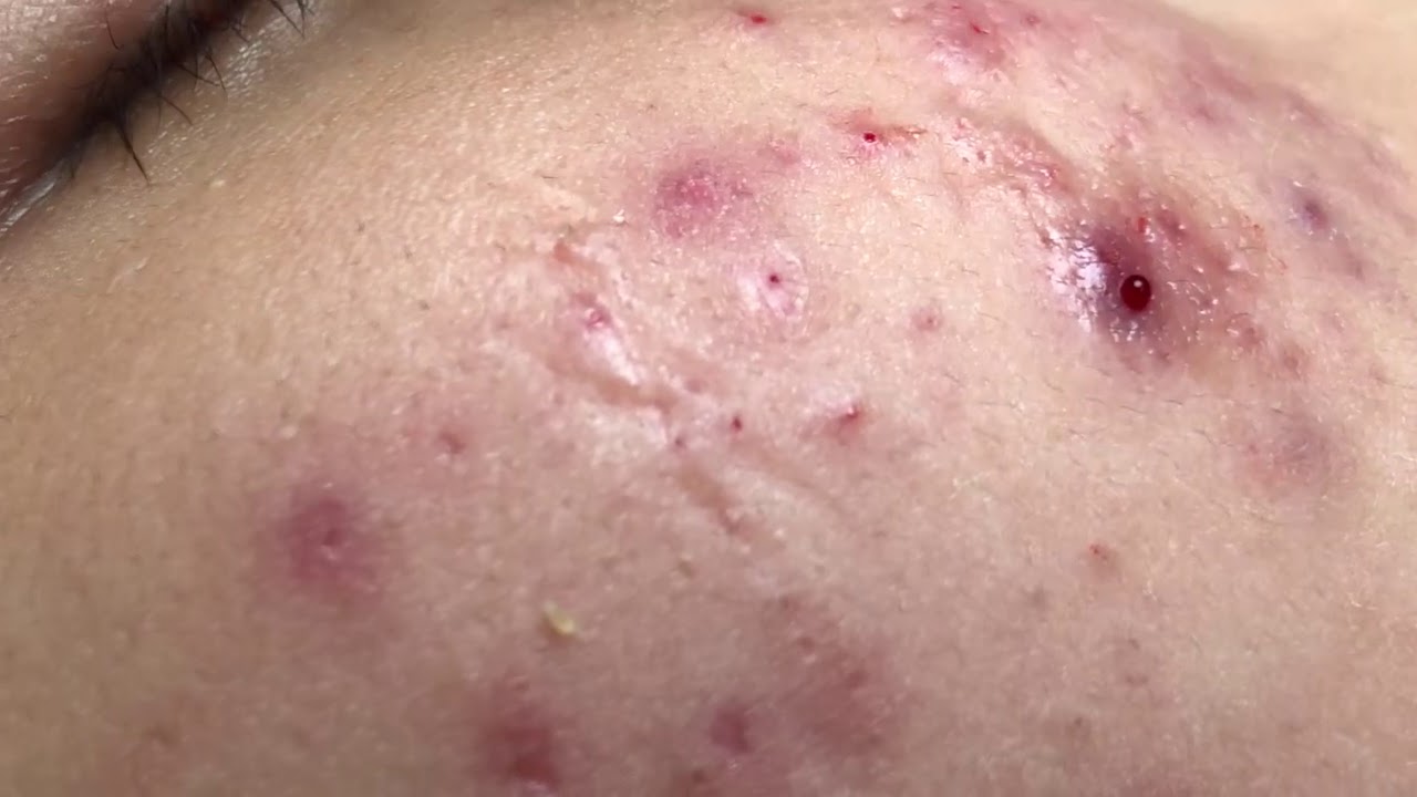 Blackheads - little but quality by Ngoc