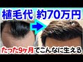 【感動】M字ハゲの悩み トルコ植毛前~9ヶ月の経過を一気に見せます!!【自毛植毛|70万円|3550株】
