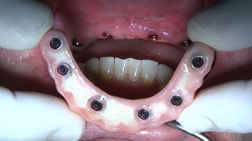 Zest LOCATOR F-Tx with Flapless Guided Navigator Surgery and an Immediate Bridge - Dr. Del Castillo