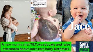 Mum using TikTok to educate about her son's rare hairy birthmark - CMN