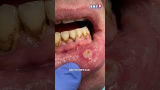 What Causes Burning &amp; Sores in the Mouth? #decc #entcare #shorts #entspecialist #mouthulcertreatment