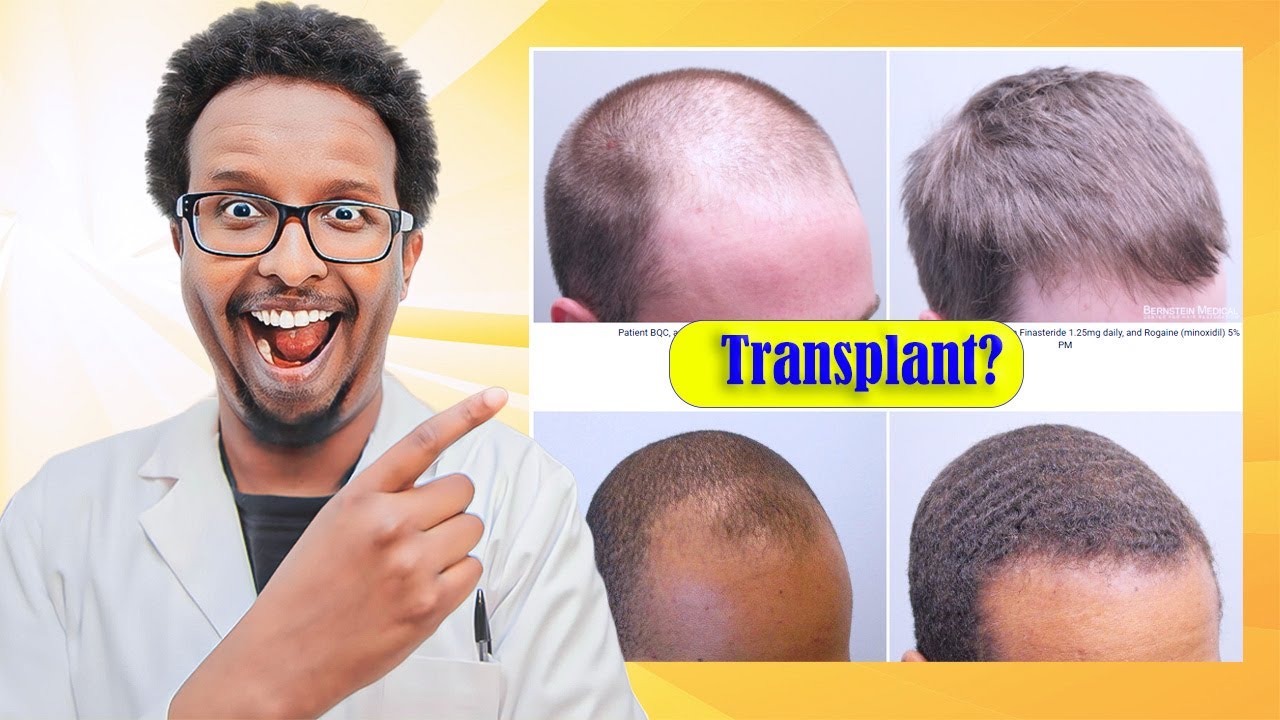 Can Meds Beat a Hair Transplant? | With Proof