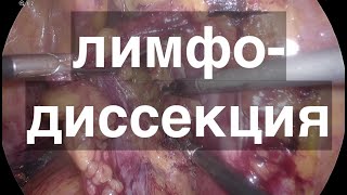 лимфодиссекция за 20 минут с двух сторон // лапароскопическая тазовая (латеральная) лимфодиссекция