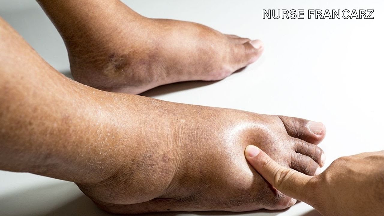 What no on tells you about swollen legs /edema/causes &home remedies