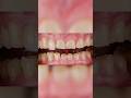 പല്ലിന്റെ തേയ്മാനം /Toothwear #teeth#arogyam#pallu#dentalcare#shorts#smiledesigner