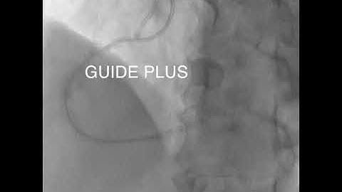 Angioplasty technique:Guide extension catheter, GUIDE PLUS.