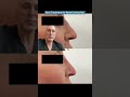 Best Treatment for Nose Contouring