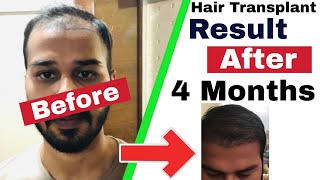Case Study : 4 Months Hair Transplant Result Timeline || Fue Hair Transplant Results
