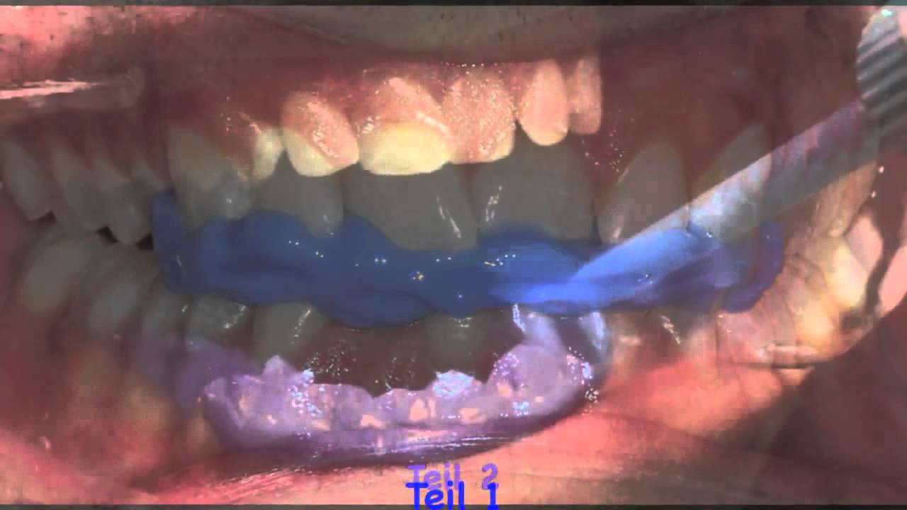 AQUALIZER, Bausch (Германия), Денталл Сервис, dentallservice.com.ua