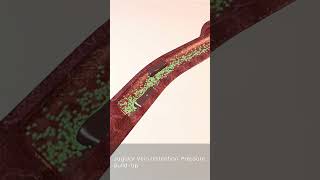 What JVD Really Means | Engorged Neck Veins Explained | RN Explains 123
