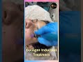Collagen Induction Treatment | Acne Scars & Anti-Aging Solution | Asthederm Mohali