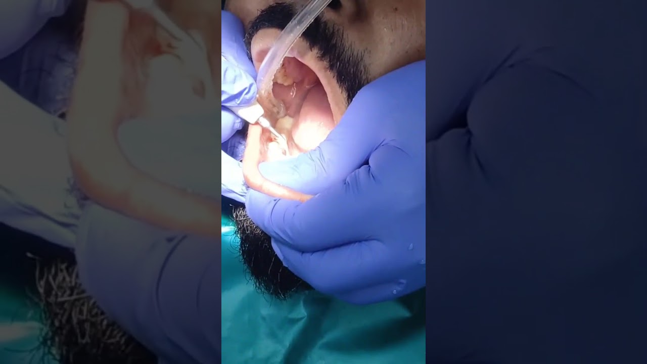 Subgingival Scaling Treatment | Advanced Dental Care Patna