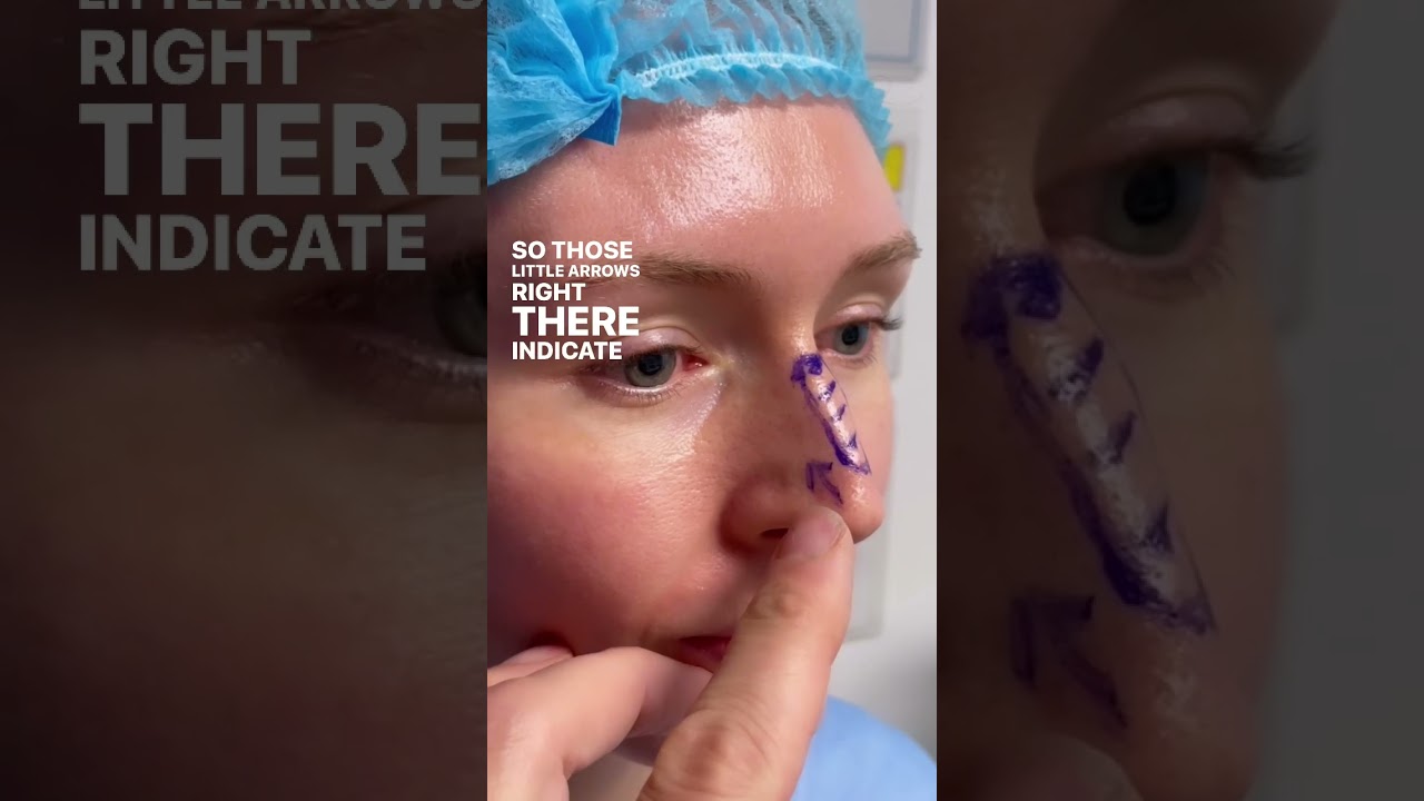 Rhinoplasty Before & After #Shorts