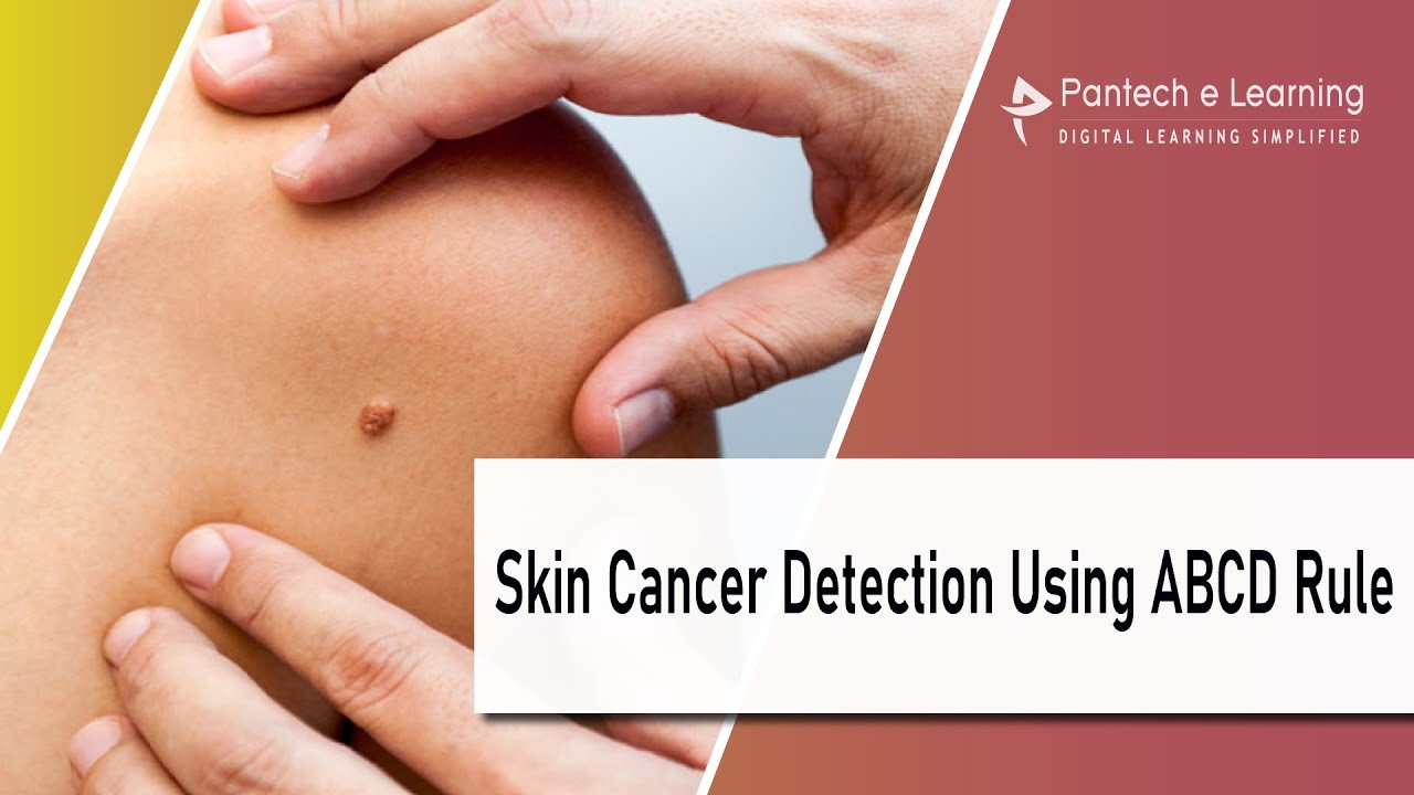 Skin Cancer Detection Using ABCD Rule| IEEE Projects | Pantech ...