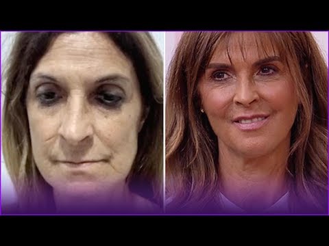 Harmonização facial: veja o antes e depois do procedimento