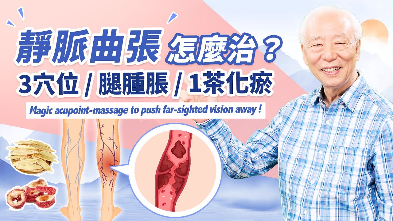 恢復腿部健康！3穴位，改善腿腫脹、浮腳筋。1動作+1茶飲，讓下肢血液循環通暢。這1種靜脈曲張需治療。小心！穿壓力襪造成缺血。 中醫放血療法，有效治靜脈曲張｜ 胡乃文開講Dr.HU_199