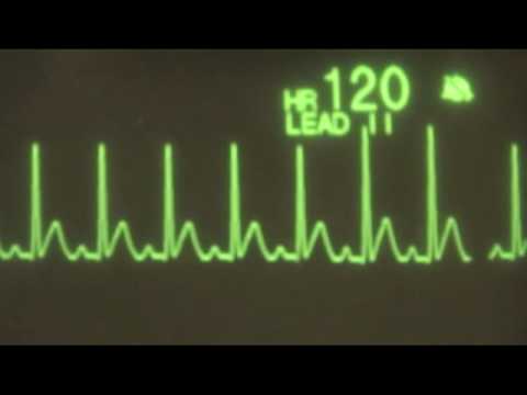 Sinus Tachycardia Ecg Training Youtube