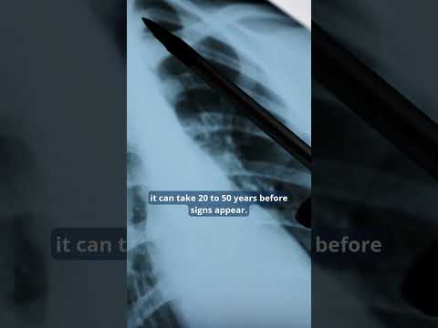 Mesothelioma Cases In KC: A Vimeo Prediction That Will Surprise You