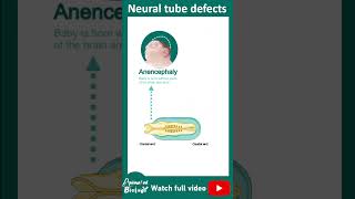 Neural tube defects | 1 minute pathology