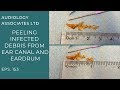 PEELING INFECTED DEBRIS FROM EAR CANAL AND EARDRUM - EP153