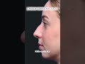 How Long Does Facial Plastic Surgery Last?