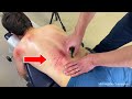  purple bruising on mans back   pain in other placesunintentional elbow asmr  crunchy