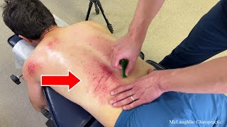 😳 Purple Bruising On Man's Back = Pain In Other Places...Unintentional ELBOW ASMR ~ 🔊CRUNCHY