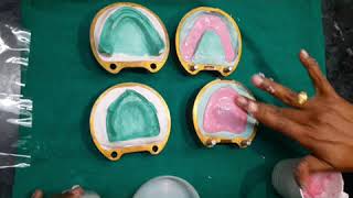 Compression molding technique for denture fabrication