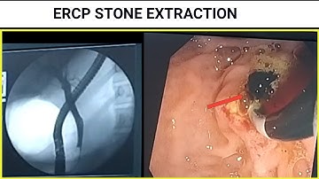 Choledocholithiasis & Cholangitis ERCP Stone Extraction at SQUARE HOSPITALS LTD Dhaka #BD_ENDOSCOPY