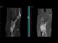 Pathologic fracture of unicameral bone cyst in radius