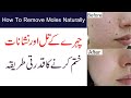 Chehre ke kale til khatam karne ka asan tarika  how to remove black and brown moles naturally