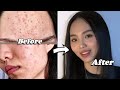 5 tips for Clear Skin: How I got rid of Acne / Breakouts Remedy at home skin care routine x AMRIO