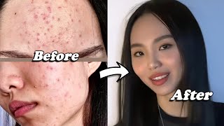 5 tips for Clear Skin: How I got rid of Acne / Breakouts Remedy at home skin care routine x AMRIO