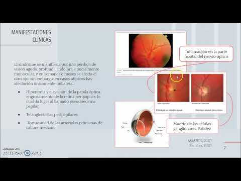 Neuropatía óptica hereditaria