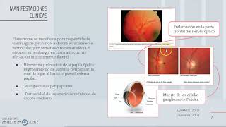 Neuropatía óptica hereditaria de Leber Síndrome de LHON