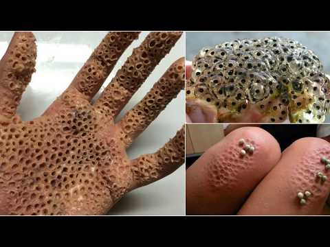 Padeces esta enfermedad Test Tripofolia